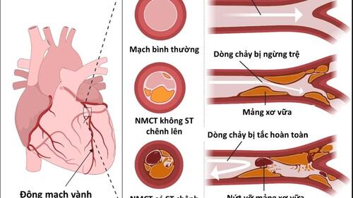 HỘI CHỨNG ĐỘNG MẠCH VÀNH CẤP KHÔNG CÓ ST CHÊNH LÊN