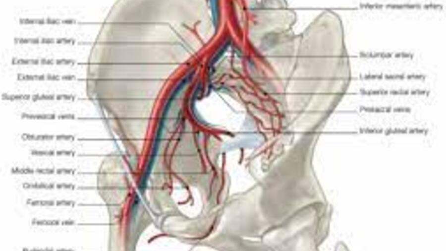 PHẪU THUẬT THÀNH CÔNG BỆNH NHÂN U HẠ VỊ XÂM LẤN ĐỘNG MẠCH CHẬU VÀ NIỆU QUẢN (PHẢI)