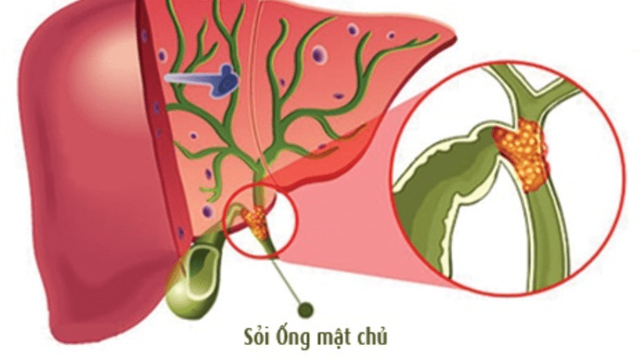 SỎI ỐNG MẬT CHỦ - SỎI TRONG GAN KÍCH THƯỚC LỚN HIẾM GẶP