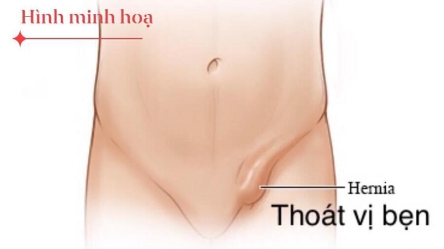 PHẪU THUẬT NỘI SOI ĐIỀU TRỊ THOÁT VỊ BẸN HAI BÊN