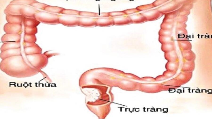 PHẪU THUẬT THÀNH CÔNG CẤP CỨU TẮC RUỘT DO U TRỰC TRÀNG