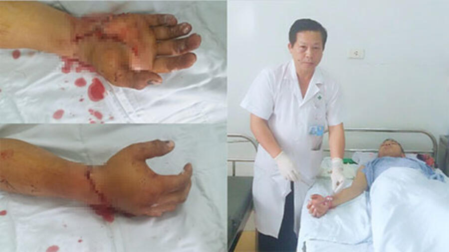 Bệnh viện 19-8 nối thành công bàn tay bị chém đứt rời