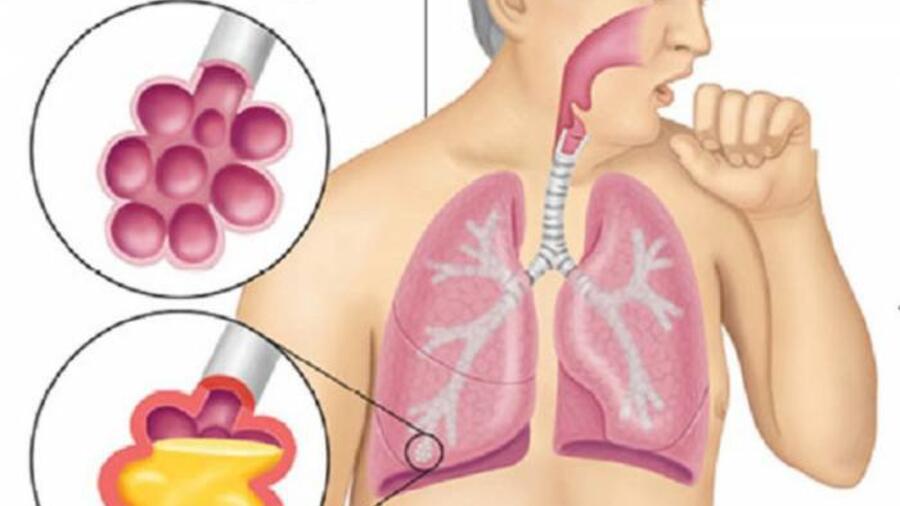 PHẪU THUẬT THÀNH CÔNG BỆNH NHÂN U NẤM PHỔI