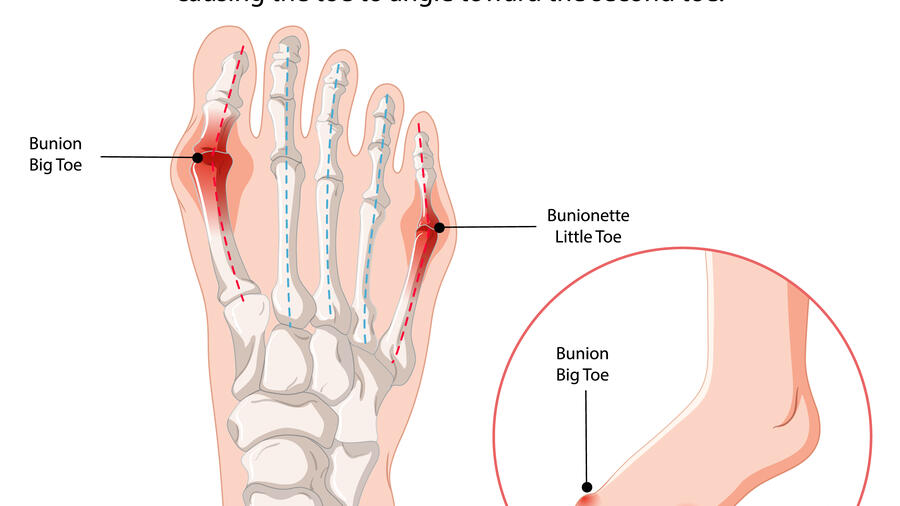 HƯỚNG DẪN CHẨN ĐOÁN VÀ ĐIỀU TRỊ BỆNH GÚT