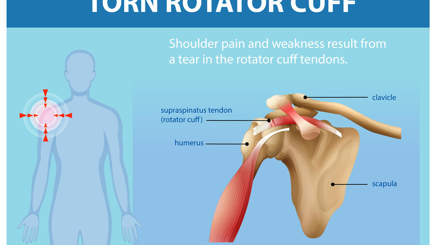 HƯỚNG DẪN CHẨN ĐOÁN VÀ ĐIỀU TRỊ VIÊM QUANH KHỚP VAI