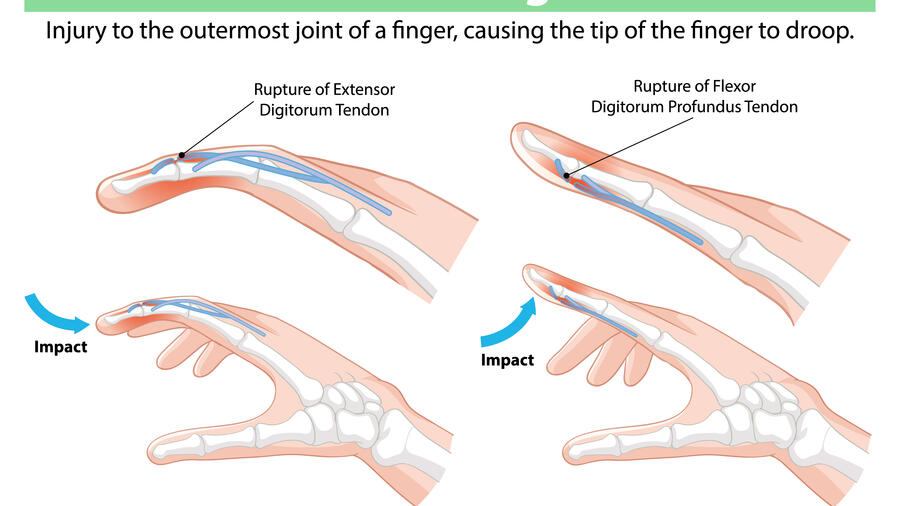 HƯỚNG DẪN CHẨN ĐOÁN VÀ ĐIỀU TRỊ NGÓN TAY CÒ SÚNG
