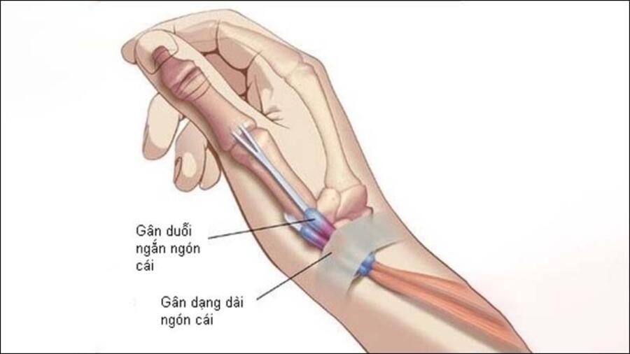 QUY TRÌNH KỸ THUẬT PHẪU THUẬT VẾT THƯƠNG BÀN TAY TỔN THƯƠNG GÂN DUỖI