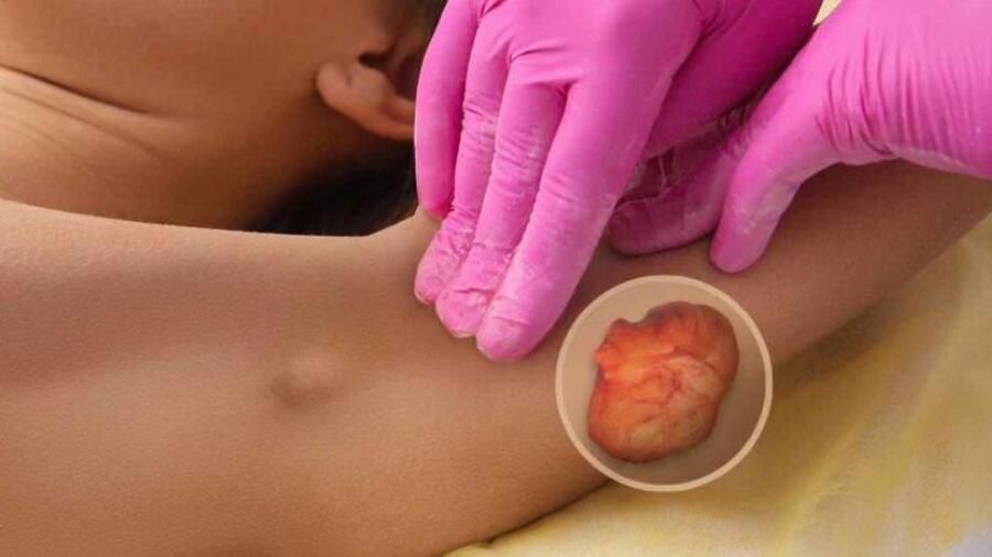 QUY TRÌNH KỸ THUẬT PHẪU THUẬT CÁC KHỐI MÔ MỀM LÀNH TÍNH QUY TRÌNH KỸ THUẬT PHẪU THUẬT CÁC KHỐI MÔ MỀM LÀNH TÍNH