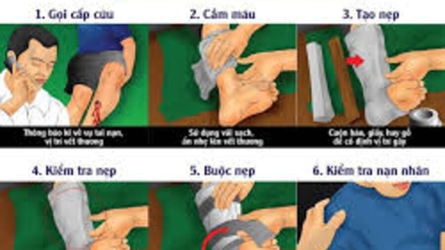 QUY TRÌNH KỸ THUẬT SƠ CẤP CỨU BỆNH NHÂN GÃY XƯƠNG