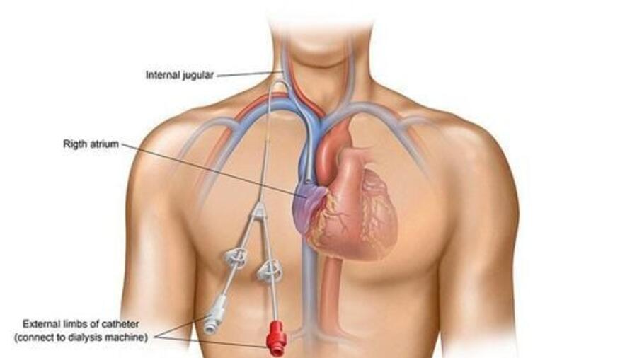 QUY TRÌNH KỸ THUẬT THIẾT LẬP ĐƯỜNG TRUYỀN TĨNH MẠCH NGOẠI BIÊN