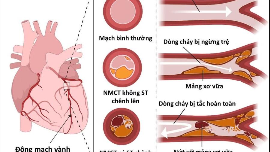 HỘI CHỨNG ĐỘNG MẠCH VÀNH CẤP KHÔNG CÓ ST CHÊNH LÊN