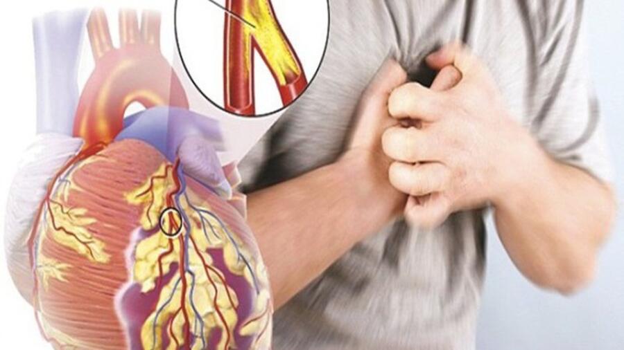 CƠN ĐAU THẮT NGỰC ỔN ĐỊNH