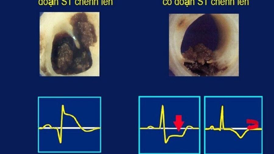 RỐI LOẠN LIPID MÁU