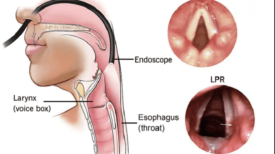 NỘI SOI HẠ HỌNG-THANH QUẢN ỐNG CỨNG/ MỀM CHUẨN ĐOÁN NỘI SOI HẠ HỌNG-THANH QUẢN ỐNG CỨNG/ MỀM CHUẨN ĐOÁN