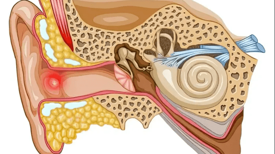 CHÍCH NHỌT ỐNG TAI NGOÀI