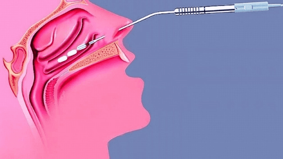 NHÉT BẤC MŨI TRƯỚC