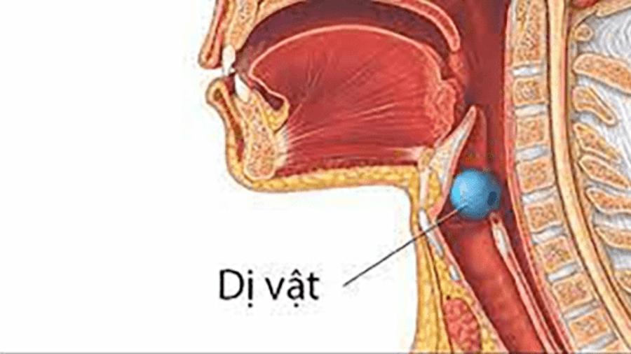 LẤY DỊ VẬT HỌNG MIỆNG
