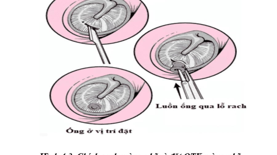 CHÍCH RẠCH MÀNG NHĨ