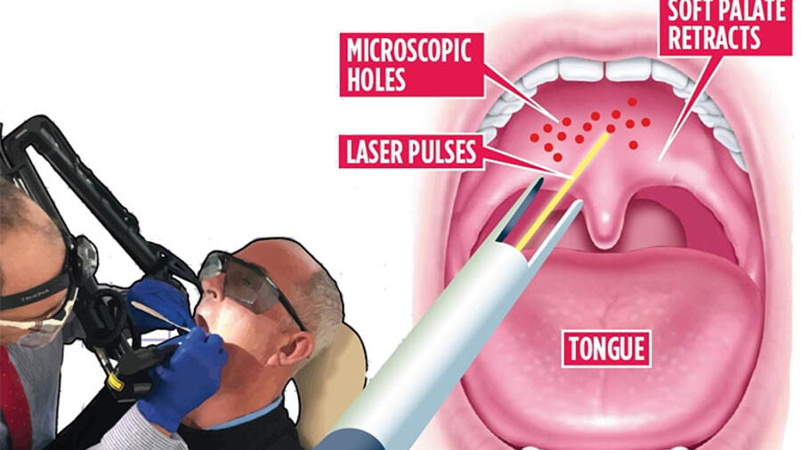 ĐỐT HỌNG HẠT BẰNG NHIỆT