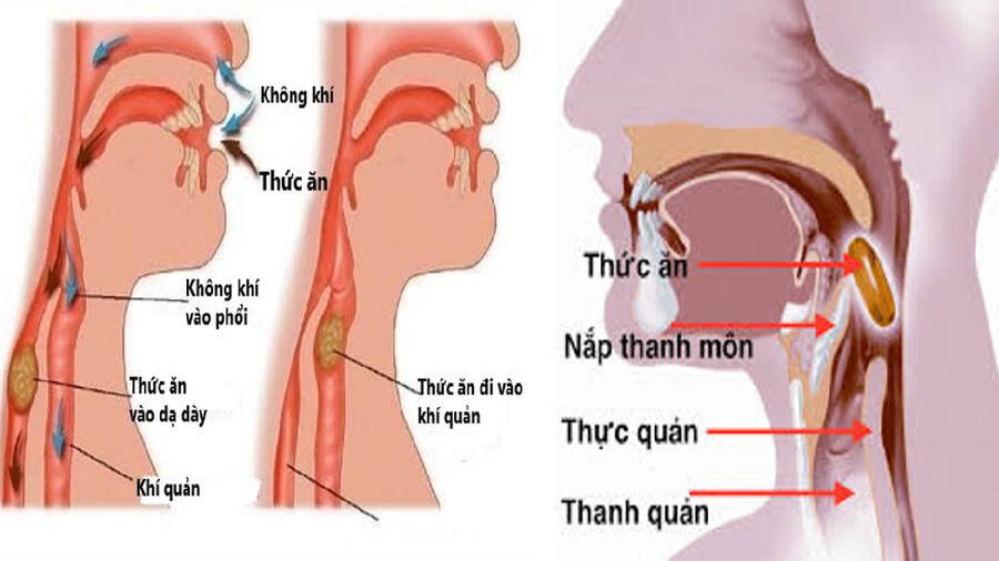 LẤY DỊ VẬT HẠ HỌNG