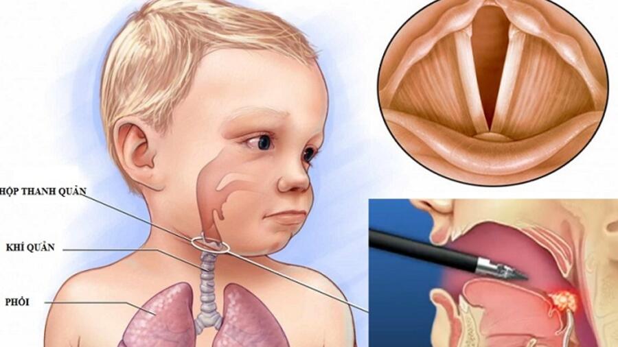 NỘI SOI MŨI/ VÒM/ HỌNG CẮT ĐỐT ĐIỆN BẰNG ĐIỆN CAO TẦN