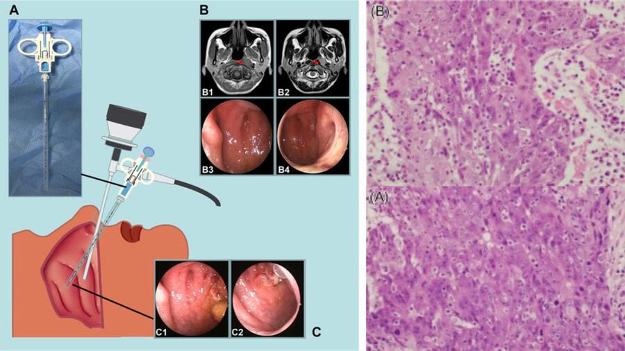 NỘI SOI MŨI/ VÒM/ HỌNG CÓ SINH THIẾT NỘI SOI MŨI/ VÒM/ HỌNG CÓ SINH THIẾT