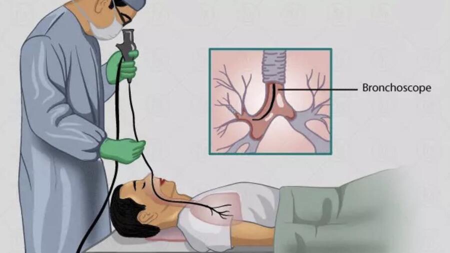 NỘI SOI PHẾ QUẢN ỐNG MỀM CHUẨN ĐOÁN GÂY TÊ