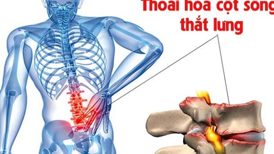 BỆNH THOÁI HÓA CỘT SỐNG THẮT LƯNG