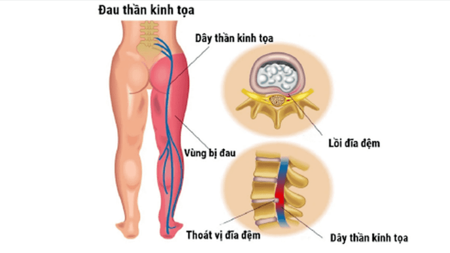 ĐAU THẦN KINH TOẠ