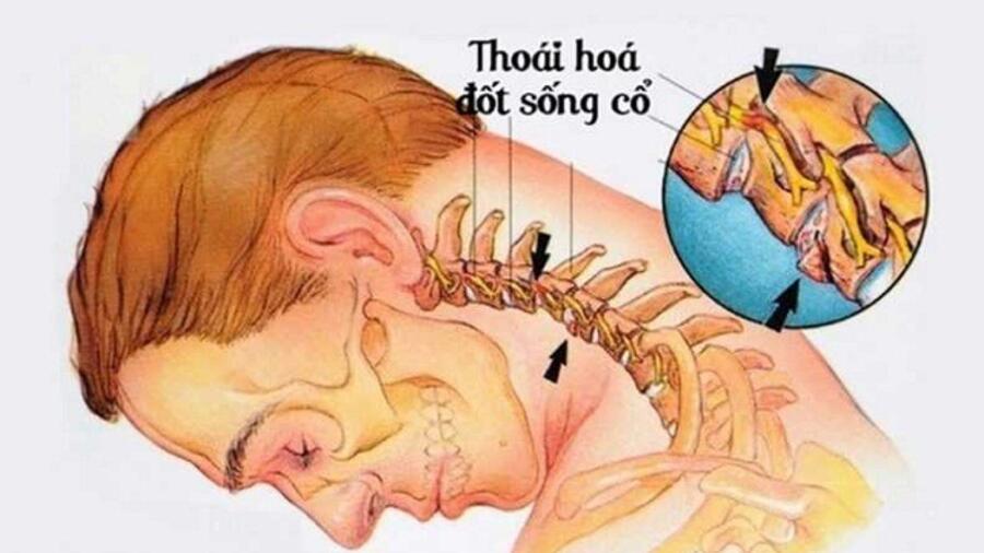 BỆNH THOÁI HÓA CỘT SỐNG CỔ
