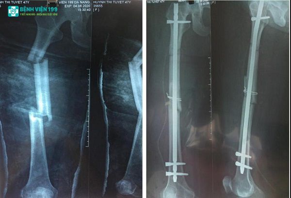 Một trường hợp Gãy Phức tạp xương đùi đã được mổ kết hợp xương bởi các bác sỹ Bệnh viện 198