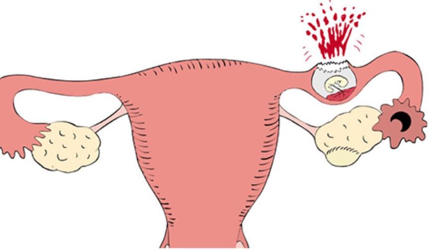 Khoa Sản Bệnh viện 19-8 cứu sống sản phụ shock mất máu do chửa ngoài tử cung vỡ