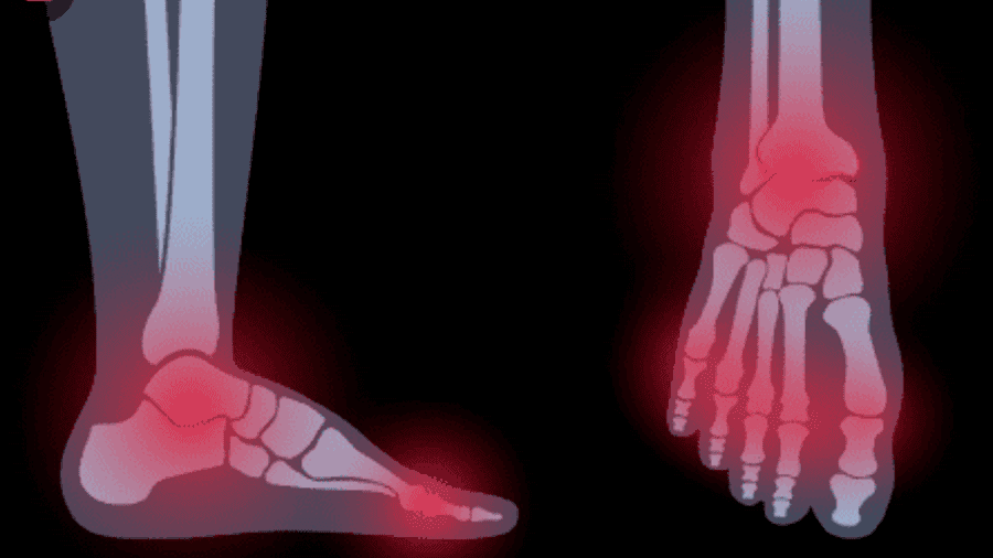 HƯỚNG DẪN CHẨN ĐOÁN VÀ ĐIỀU TRỊ VẾT THƯƠNG MẤT DA VÙNG GÓT